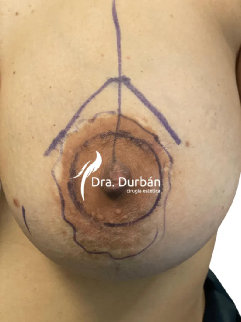 Reducción de areola: una cirugía sencilla para conseguir un pecho más armónico