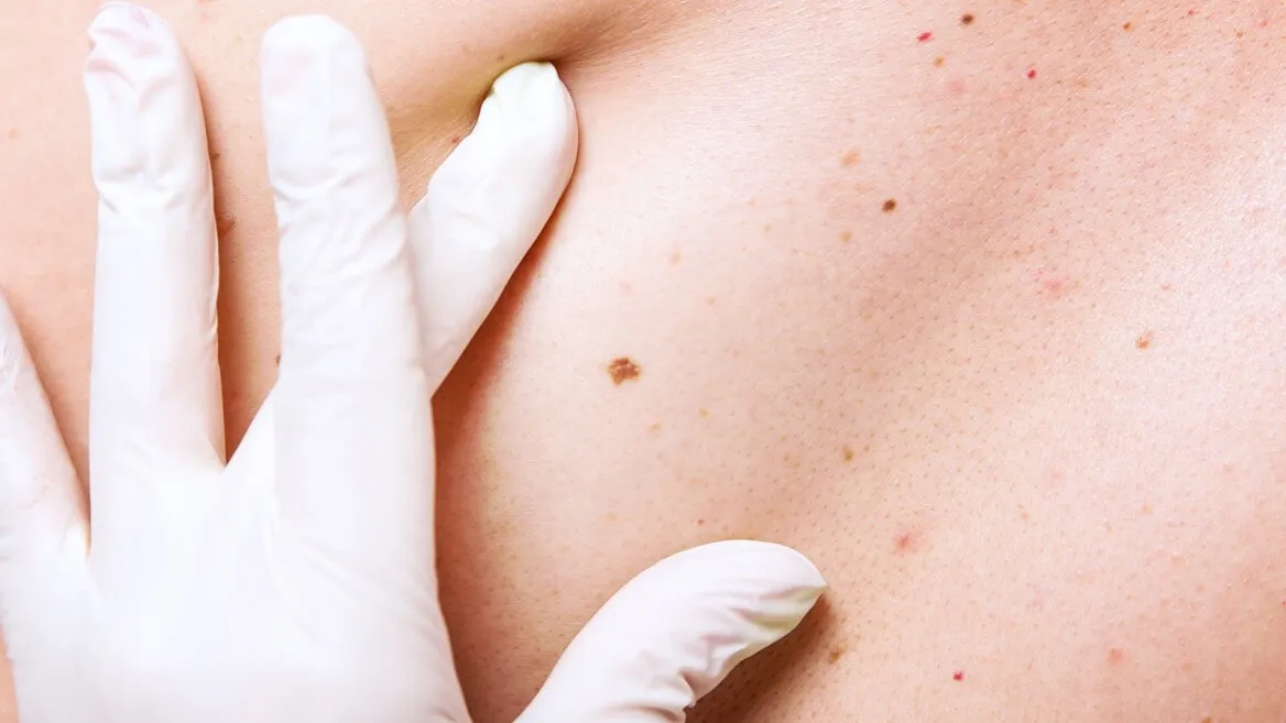 Lunares, verrugas y fibromas. Qué son y cómo quitarlos