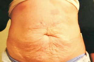 Abdominoplastia — antes