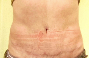 Abdominoplastia — después