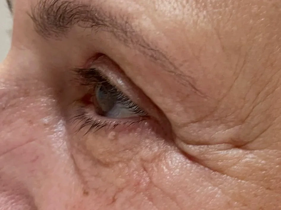 Blefaroplastia — después