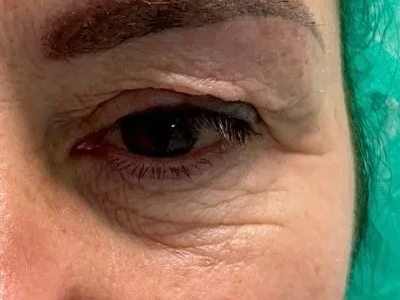 Blefaroplastia — antes