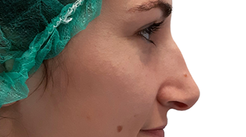 Rinoplastia — antes